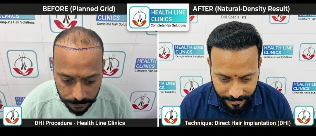 DHI procedure — planned grid before and natural-density result after
