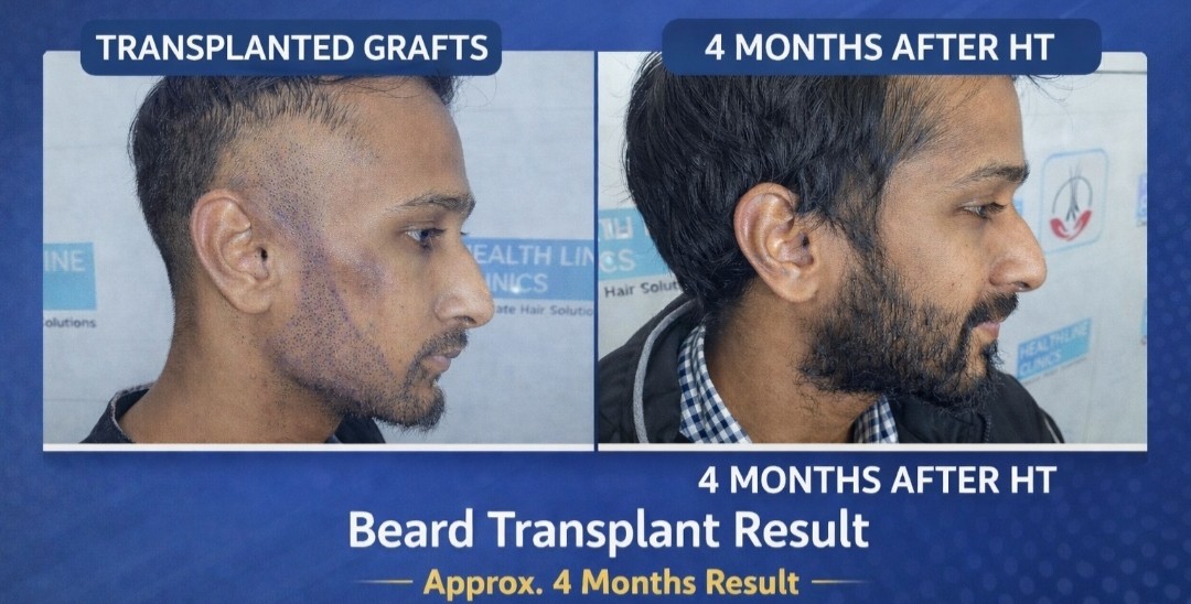 Beard transplant result approximately 4 months after the procedure