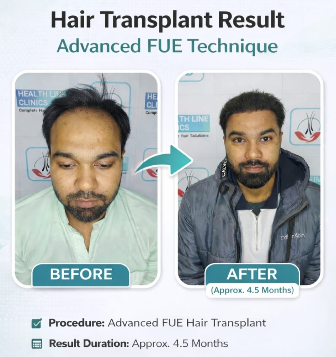 Hair transplant result using Advanced FUE technique — before and after