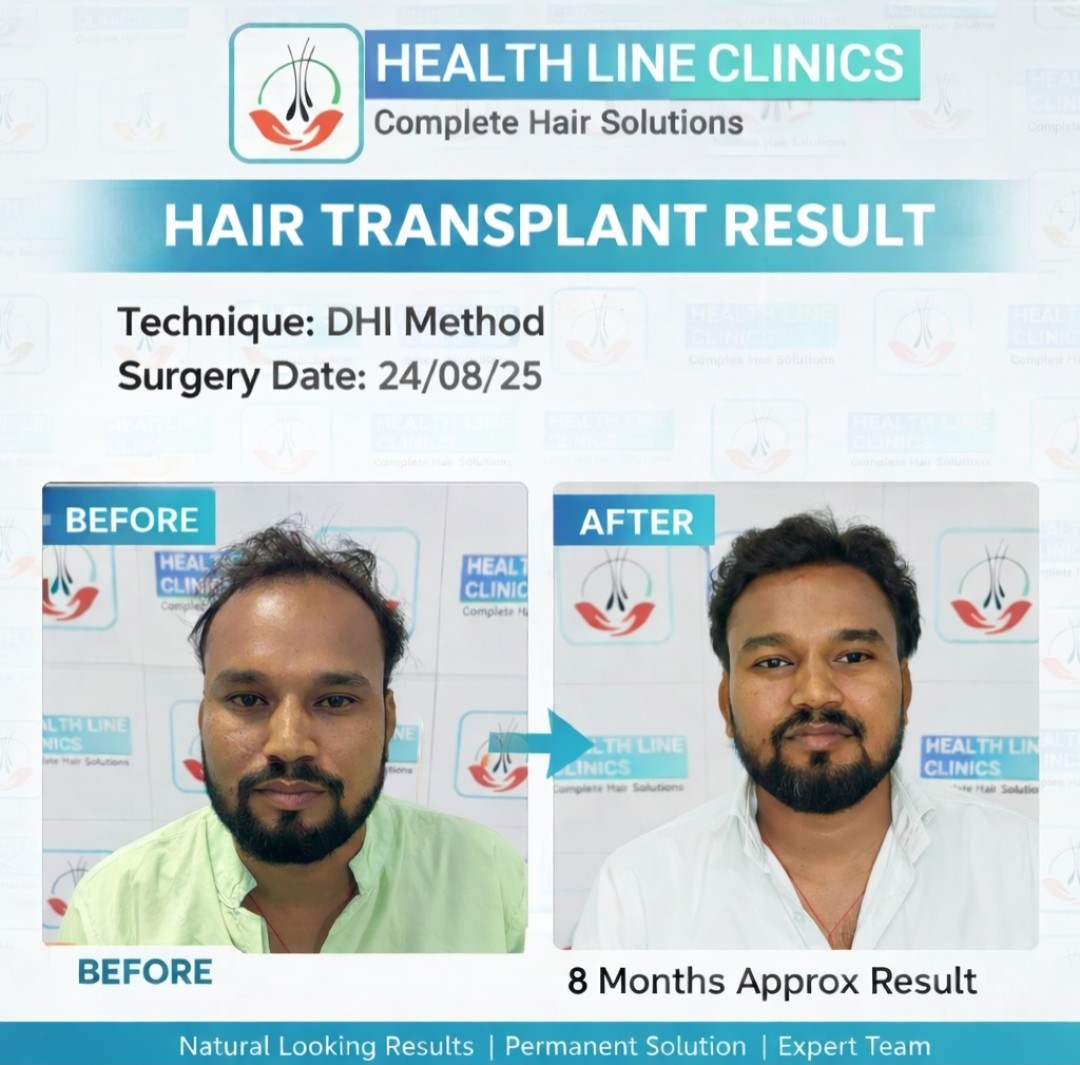Advanced FUE hair transplant result after approximately 4.5 months