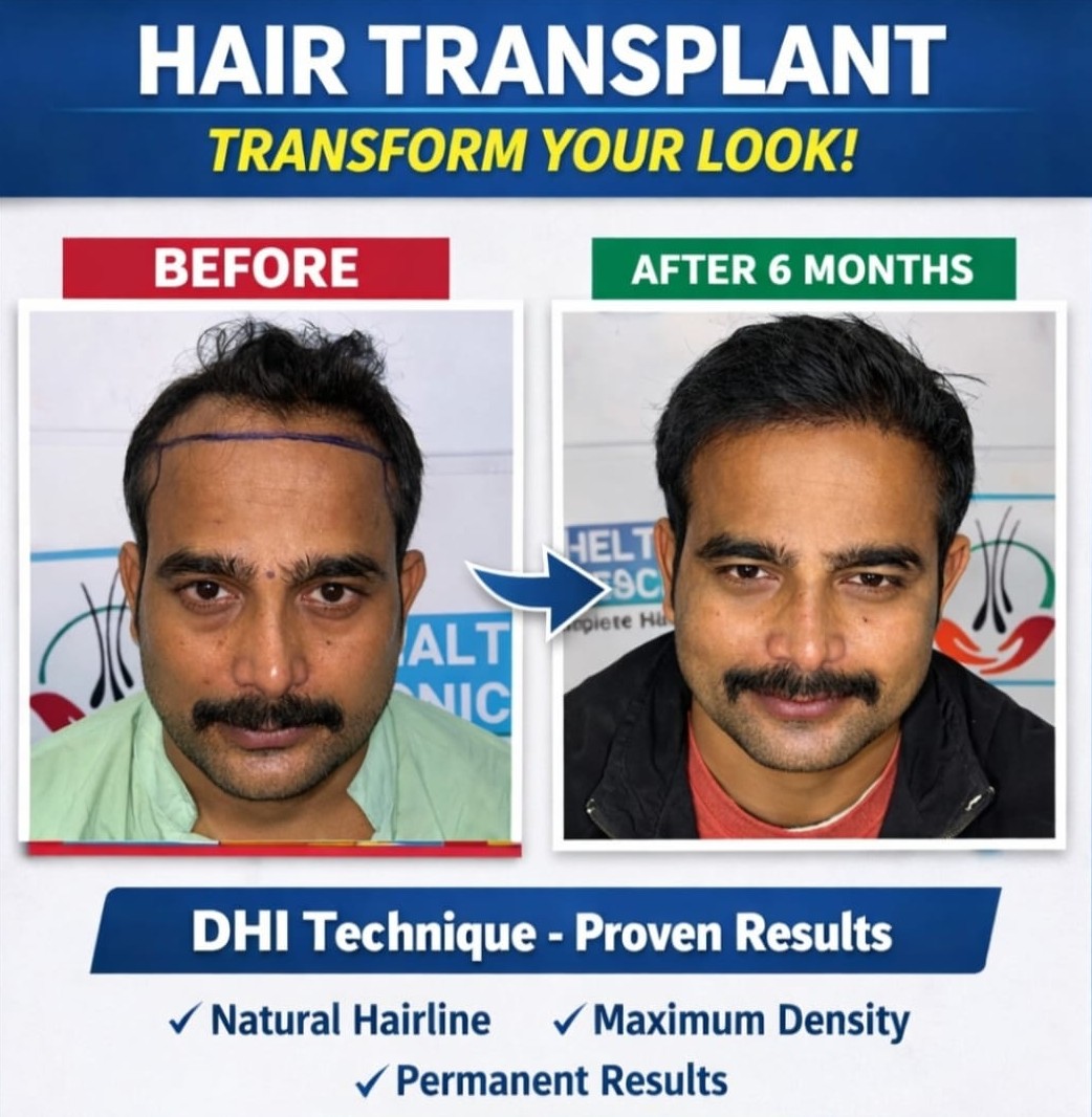 DHI technique hair transplant — before and after 6 months